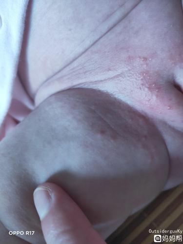 宝宝屁股起这种红痘痘了咋办啊?是不是尿不