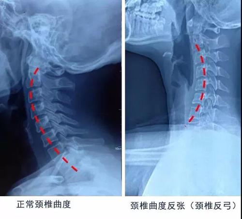 惊,年纪轻轻,居然颈椎反弓!