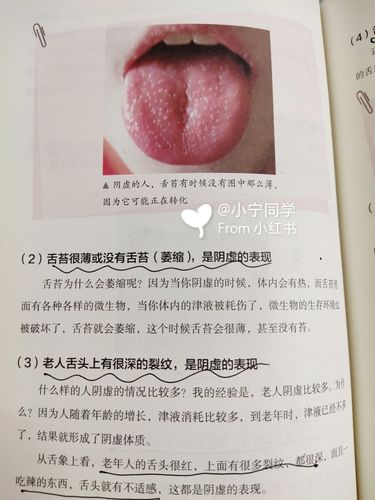 自学舌诊866阴虚体质的人舌象是什么样子?
