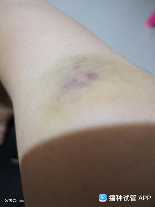            我都是去诊所打也淤青