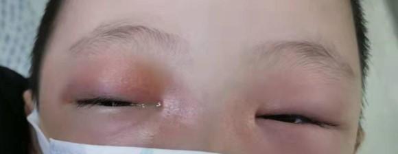 未闭合的骨缝入侵到眼部,引起眼睑红肿,眼睛疼,睁不开眼,甚至是眼球