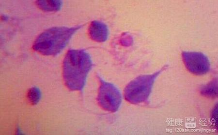 男人得了滴虫病有什么症状