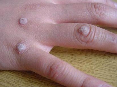 像:鱼鳞痣,建议及时到医院就诊.