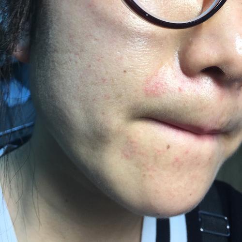 脸上反复长一块藓一样的东西,过两天就起皮,好了又长咋回事