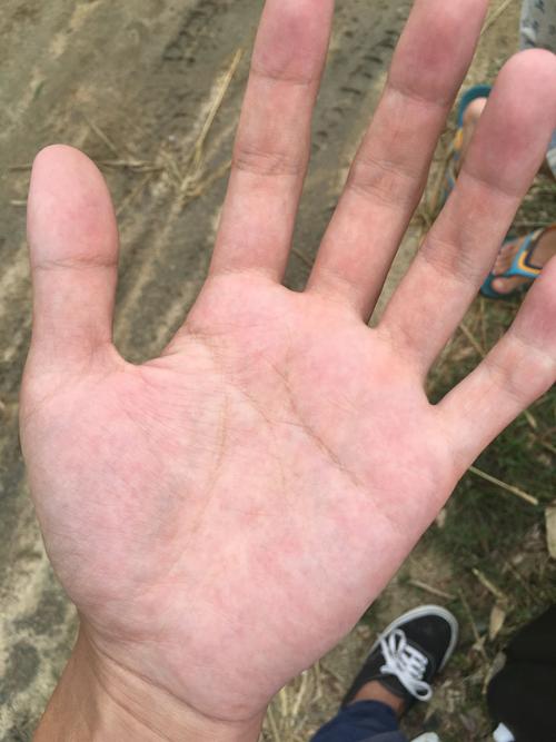 手掌心总是出现这种红色斑点,什么原因?今年二十岁,男生,感谢回答