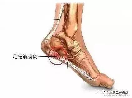炎疼痛区位置图跖筋膜炎一足跟痛常见以下几类:1,跖筋膜炎;2,跟下脂肪