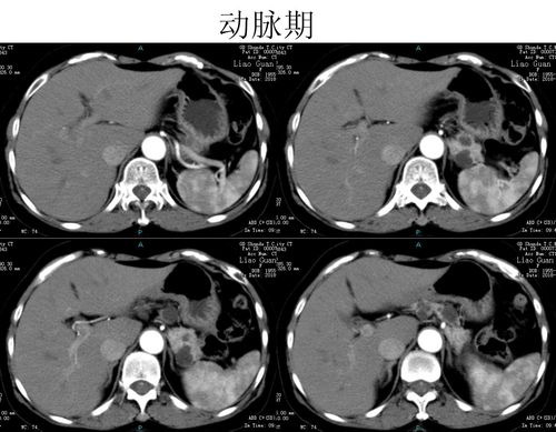 738740 没有确诊的少见病例(补充颅脑mr片)