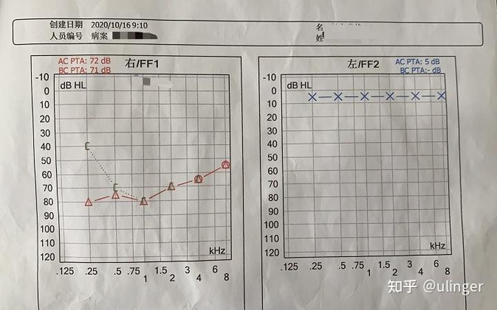 16号门诊开药那天的听力报告(ac平均下降70分贝左右)