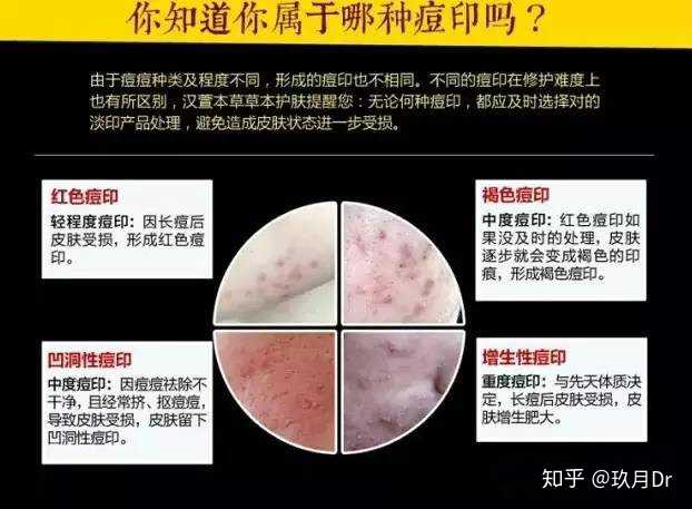 你先了解自己痘印是什么类型的吧.