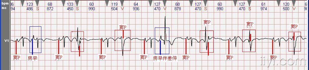 室早是单源性.呈二联律的有部分是房早伴差传.