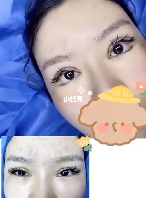 双眼皮修复提肌下至效果对比 担心肿吗_双眼皮_双眼皮