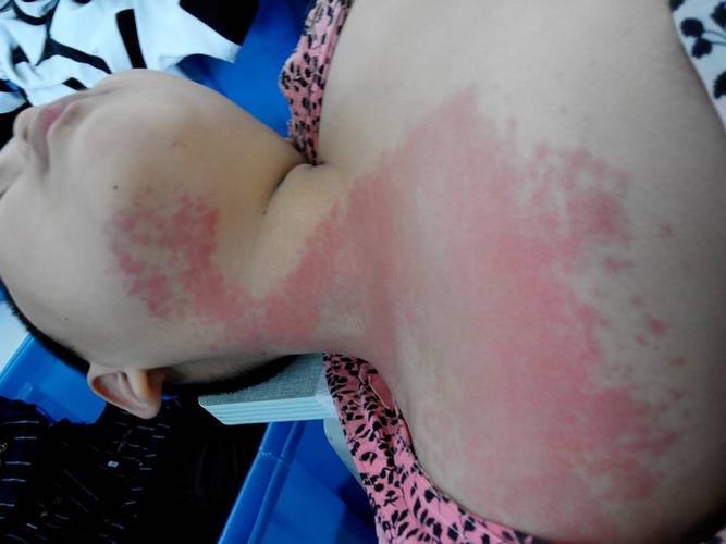 小孩身上不知是不是过敏