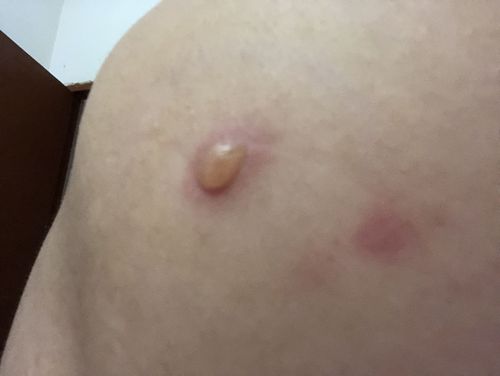 后背上长了一个大水泡,不痛不痒没感觉,洗澡的时候摸到才知道的,请问
