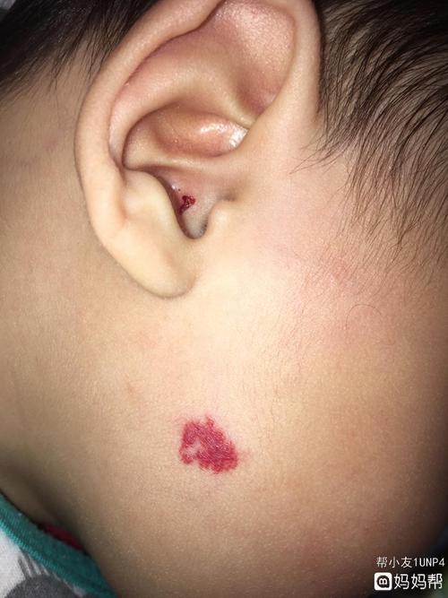 分享治疗血管瘤的亲身经历!