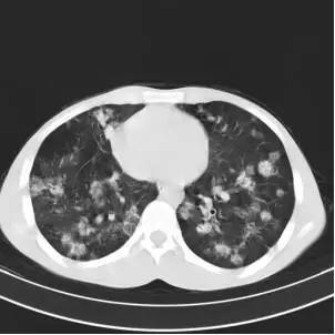 十二个病人的肺ct图像详细解读_结核