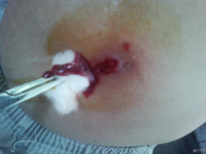 常见皮肤病———疖——深部脓疱疮——有图有真相