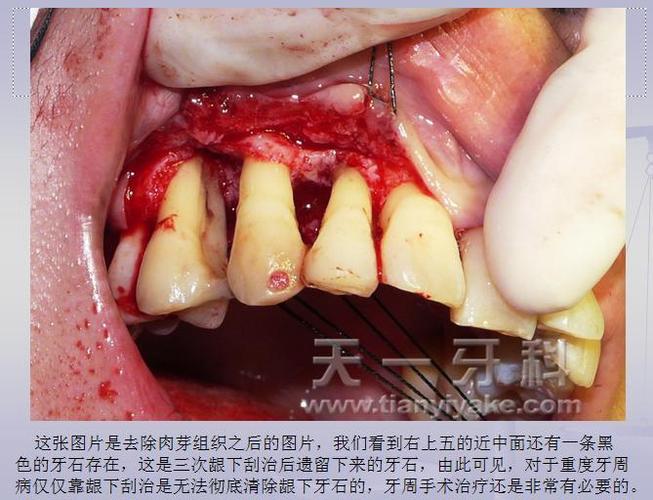 牙周翻瓣植骨手术示例