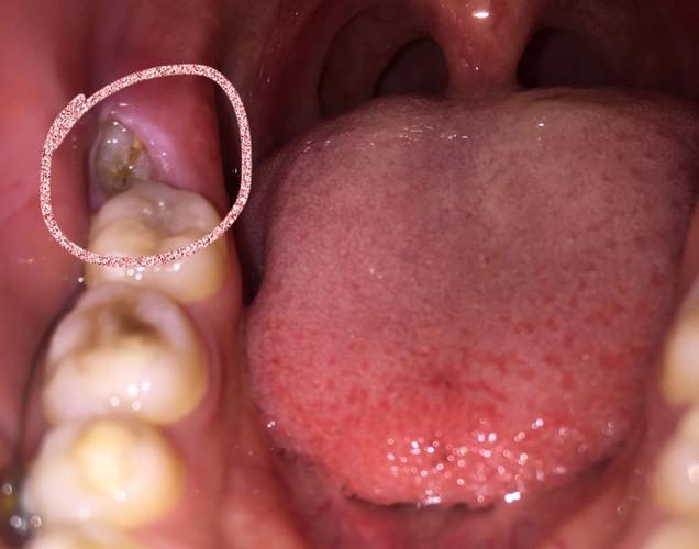 请医生看看这智齿旁边长得什么 痛了很久了 前几周还是肉包 现在肉包