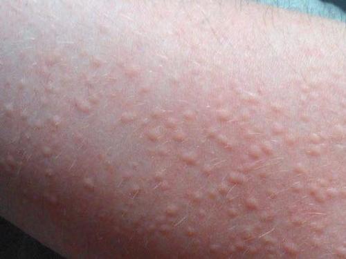 荨麻疹与某些营养素缺乏有关吗?