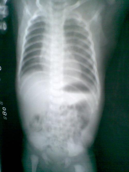 请大家分析一下左侧胃泡区液平,该片存在哪些问题.  2.