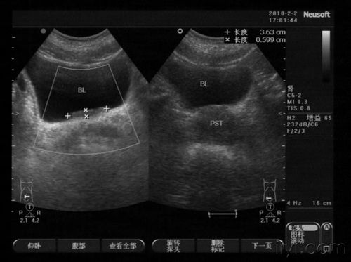 这是膀胱占位吗?
