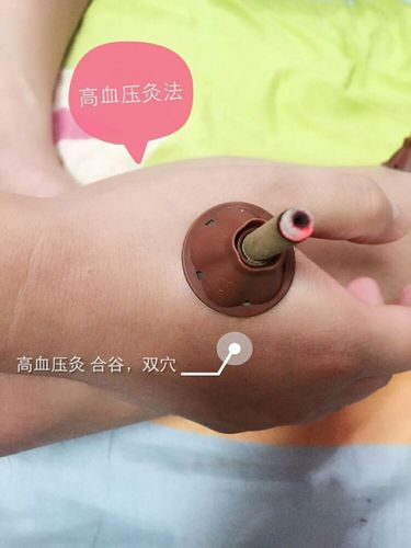 艾灸养生 艾艾贴 高血压