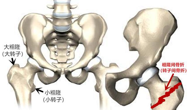 股骨粗隆间骨折是指发生在股骨大粗隆和小粗隆之间的骨折,因为大粗隆