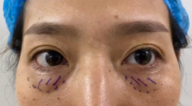 关于祛眼袋是内切还是外切?医生有话说