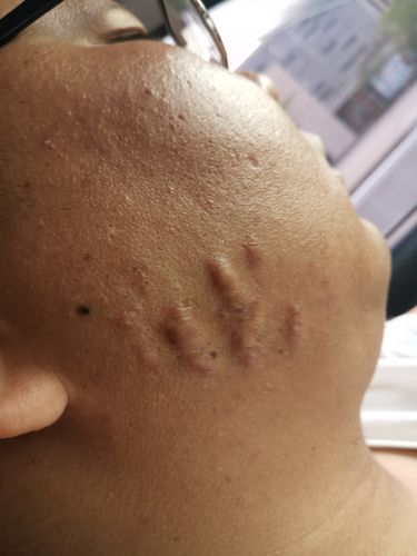 痘坑痘疤如何修复