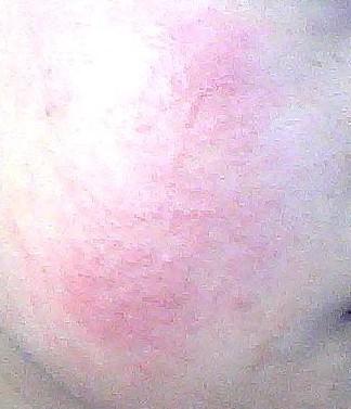 脸上长漆疮,又,红,又,肿,又,痒