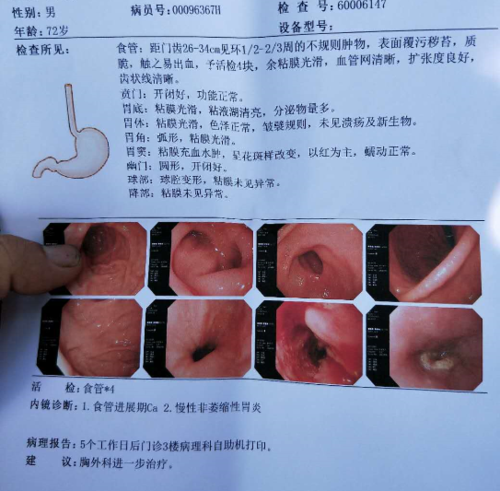 这个检查结果是食管癌吗