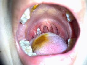 咽白喉的诊断症状为扁桃体肿大,而且表面有层假膜呈灰白色,比扁桃体大