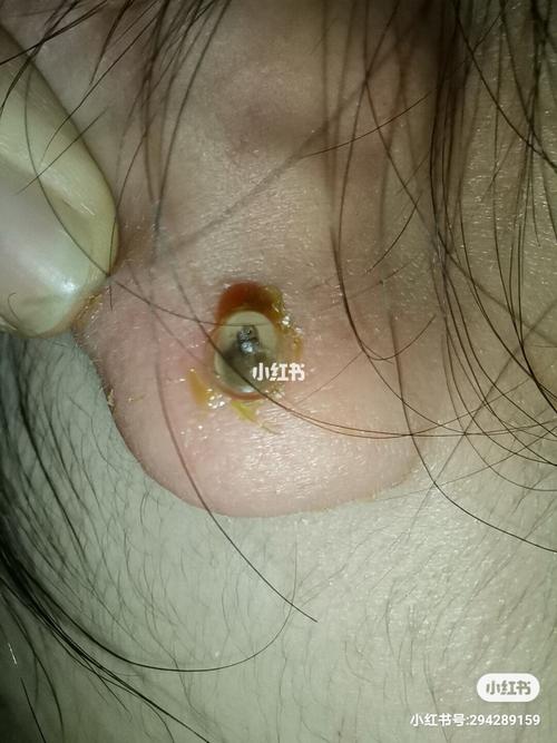 耳洞发炎流脓怎么处理 耳洞护理 我来教你_耳洞_耳钉