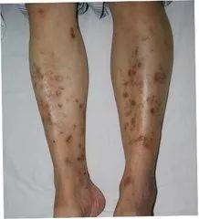 糖尿病胫前色素斑为糖尿病常见的下肢皮肤表现,早期常是无痛,小且平