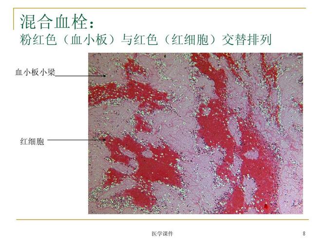 混合血栓: 粉红色(血小板)与红色(红细胞)交替排列 血小板小梁 红细胞