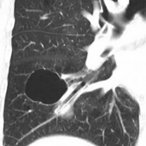 如何区分"肺大疱","肺气囊","肺囊肿"