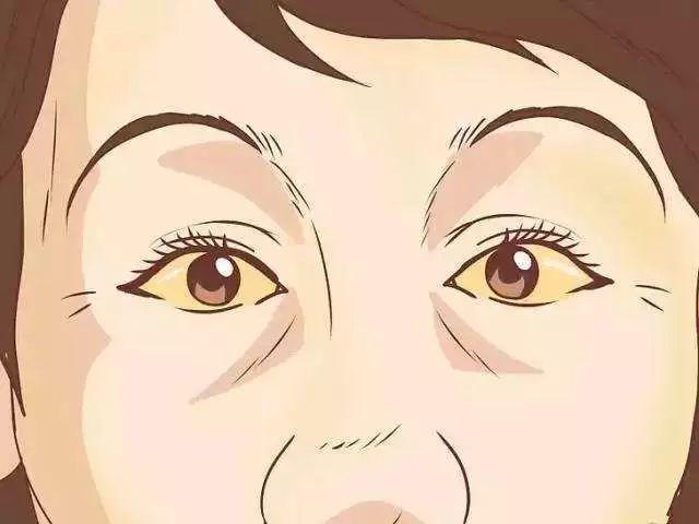 《眼医课堂》眼白混浊发黄是怎么回事?