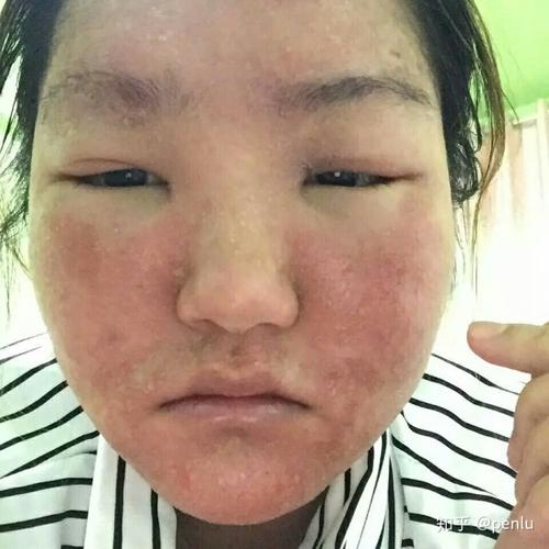 激素脸怎么痊愈?
