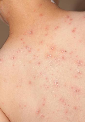 科普文小儿常见出疹性疾病的鉴别