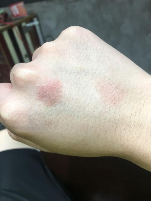 这个是癣吗?不痛不痒,就是红,比别的皮肤硬