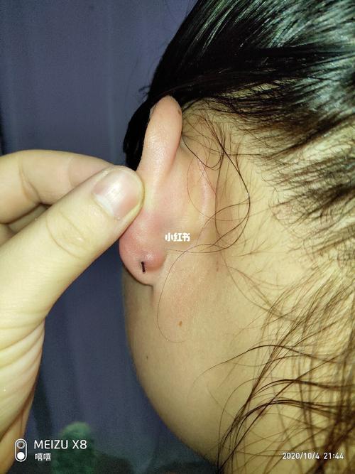 耳洞增生了_耳洞_医疗健康_医疗健康其他