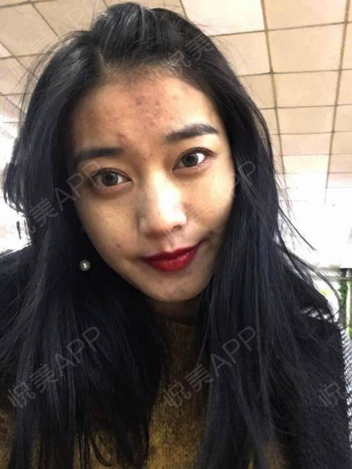 祛痘手术当天_去痘坑痘印手术当天_祛痘/痘坑/痘印手术当天_皮肤美容