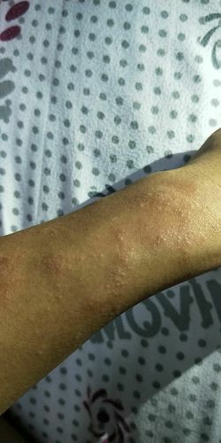 日光疹可以治愈么?