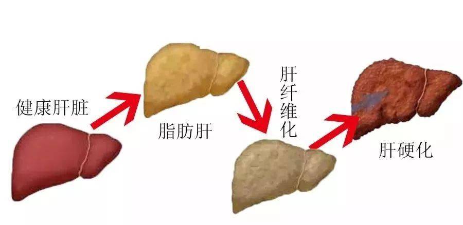 脂肪肝只是危害肝脏?错,其危害远超你的想象!