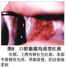 口腔红斑