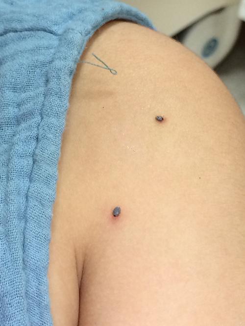 孩子皮肤上的蜱虫(北京清华长庚医院皮肤科供图)