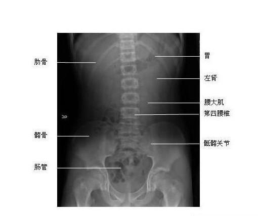 腹部正位-x线片-解剖图片