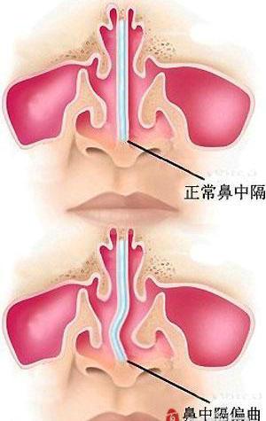 耳鼻喉科   4,邻近器官受累症状:如高位鼻中隔偏曲妨碍鼻窦引流,可