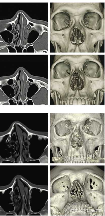 欧叔鼻整形科普为什么歪鼻矫正的患者一定要做一个鼻骨的ct