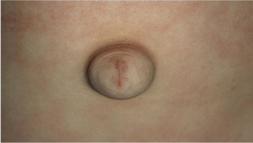 新生儿多发生在腹股沟部,腹部或阴囊处,父母可观察 孩子的大腿根,肚脐